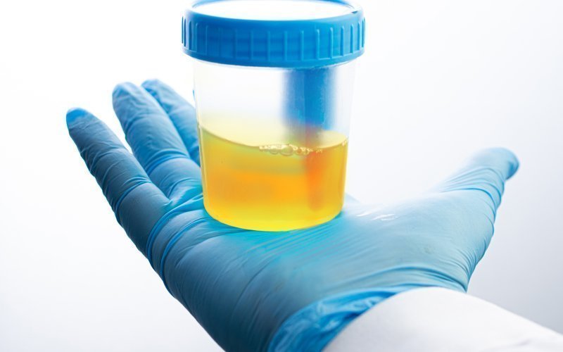 idrar rengi neden koyu olur