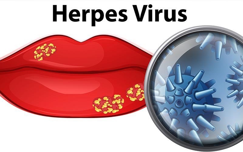 herpes virüs